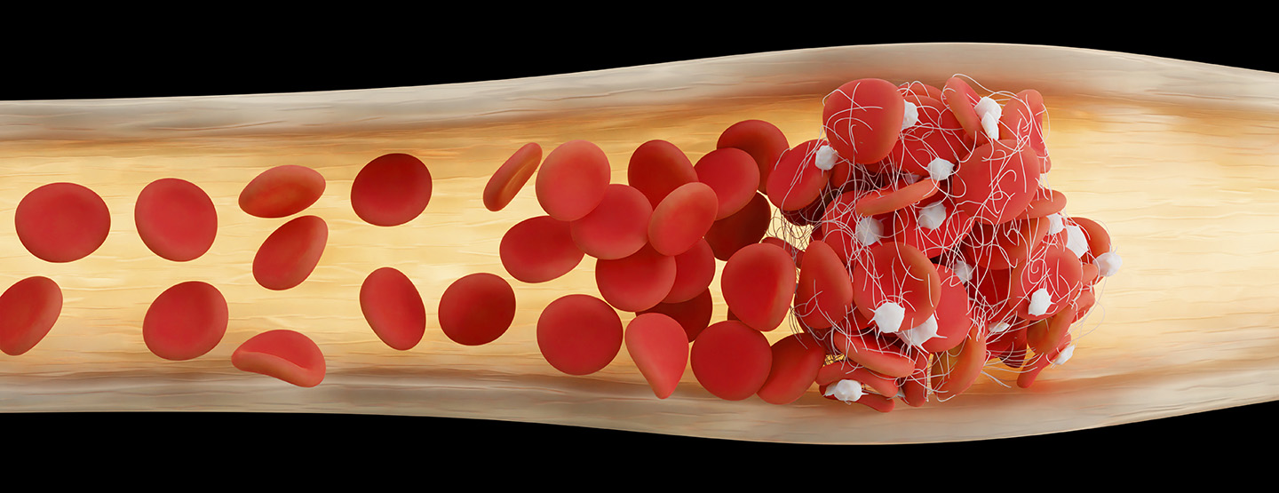 Aging Untold Extra: Parkinson’s Disease, preventing blood clots & more